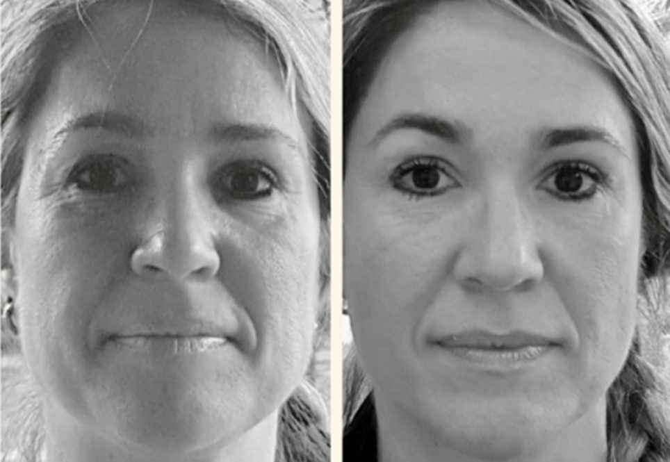 Natural Facelifting Natural Facelifting